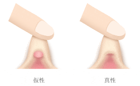 クリトリス包茎で叶える快適なインティメイトケア | ガーデンクリニック