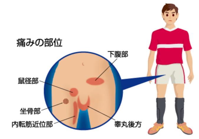 鼠径部痛症候群について | 西国立整形外科クリニック