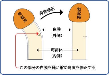 10代童貞です。勃起したあそこがこんな感じで下に曲がっています。普通- SEX・性行為 | 教えて!goo