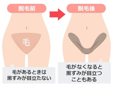 男性のパイパンはあり？女性の意見やメリットやデメリットを紹介｜風じゃマガジン