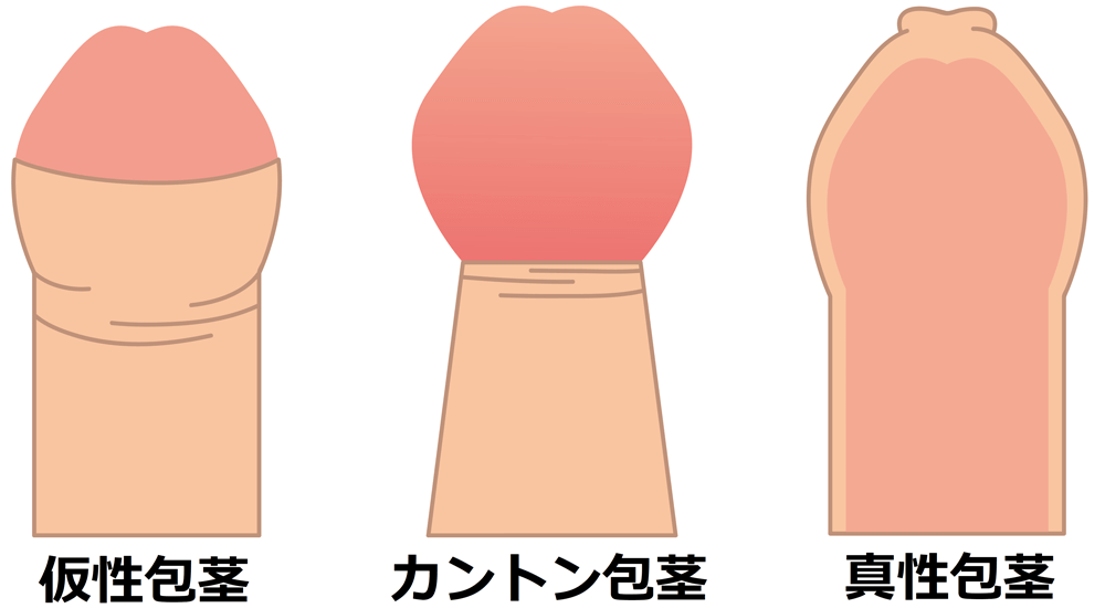 泌尿器科の専門医が徹底解説】包茎でセックスする6つのリスク