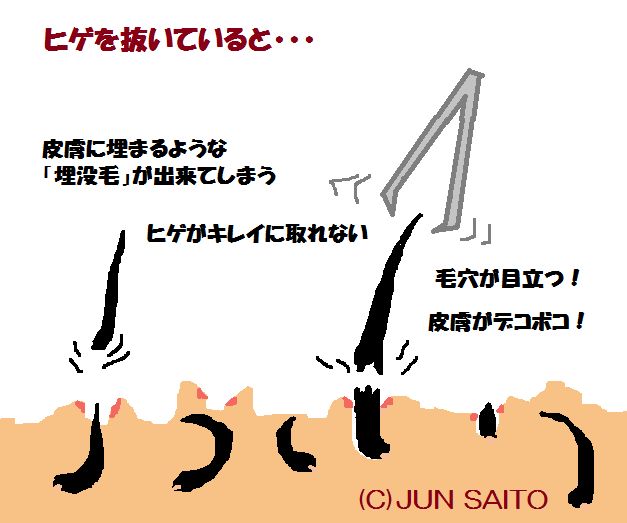 無知は怖い】脱毛後に髭を抜くとどうなるか知っていますか…？ - やってみたブログ