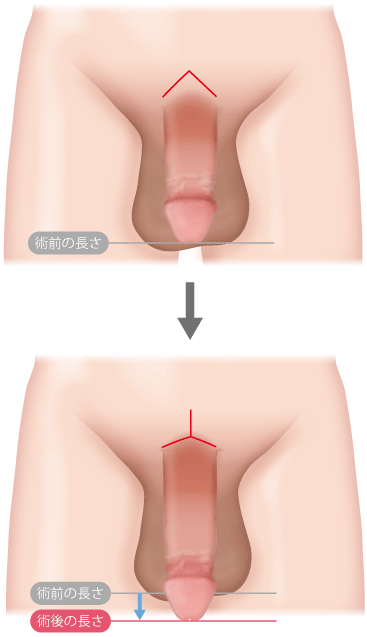 亀頭下直線切開包茎手術（クランプ法） ： 男性器（包茎、長茎など）：美容外科 高須クリニック