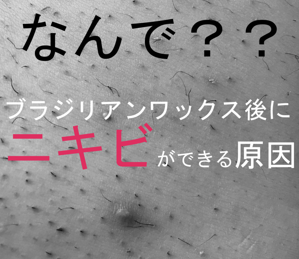 長年悩んでいた背中ニキビとニキビ跡がきれいになってうれしいです・・・お客様の声 | 