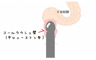 S状結腸憩室症 大腸憩室症の教科書を執筆しました |