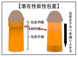 仮性包茎は治す必要がない？日本人の割合やその理由と治療方法について | コラム一覧｜ 東京の婦人科形成・小陰唇縮小・婦人科形成（女性器形成）・包茎 手術・膣ヒアルロン酸クリニック