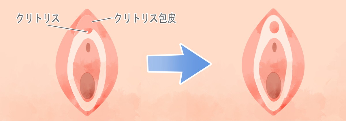 クリトリス(陰核)包茎｜美容外科・美容整形なら宮崎・大分・東京の経験豊富なコムロクリニック