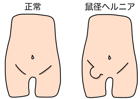 ヘルニア、鼠径ヘルニア、そけい、股関節、骨盤、筋肉、イラスト、illustrationのイラスト素材 [109291470] - PIXTA