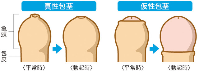 カントン包茎（嵌頓包茎）とは？手術と費用について｜MSクリニック