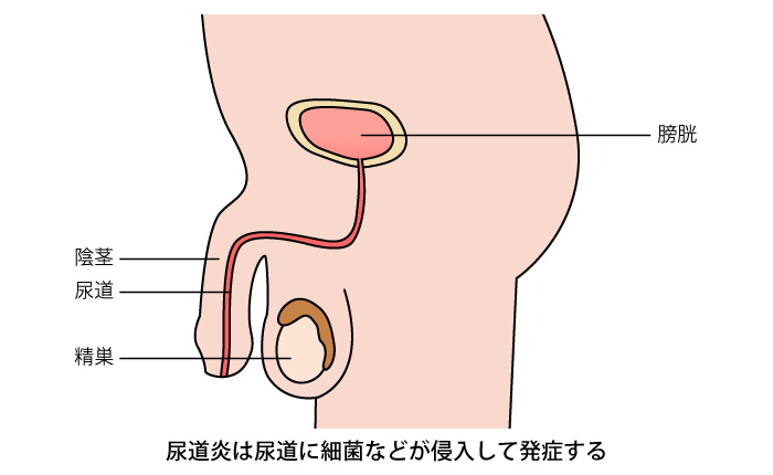 尿、おしっこをするときに痛い（排尿時痛）～女性編 | みうら泌尿器科クリニック