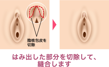 クリトリス包茎 | ゆかりレディースクリニック 神戸市三宮にある婦人科