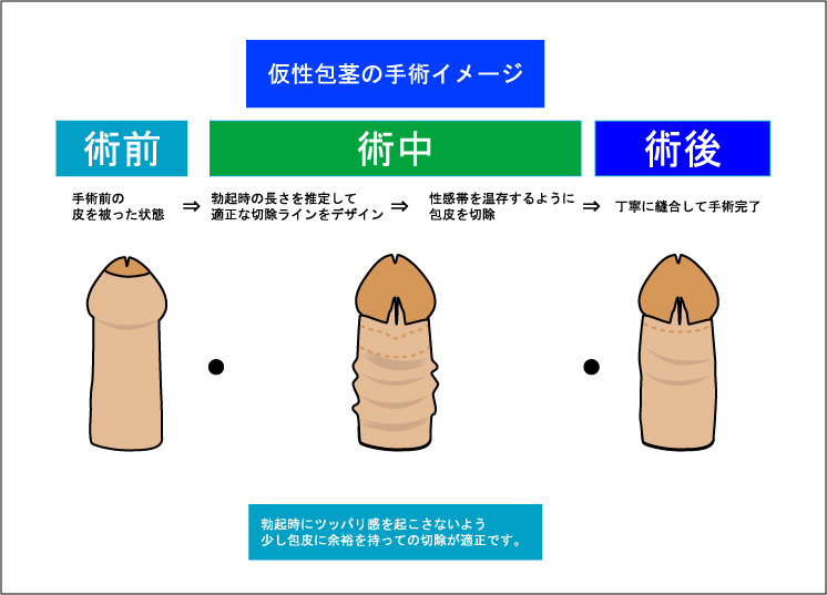 仮性包茎で皮余る現象｜原因と解決策を徹底解説