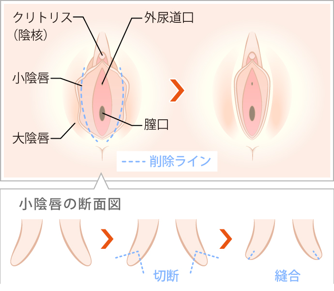 クリトリス（陰核）包茎手術 | 婦人科形成 |