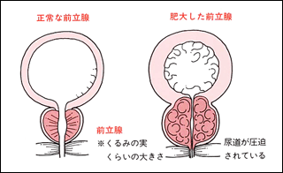 血尿（尿に血液が混じる、健診で尿潜血を指摘） | 東京泌尿器科クリニック上野