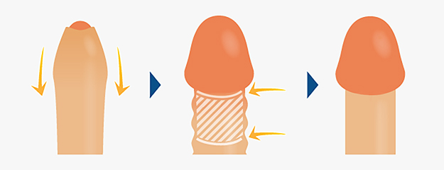 包茎のコンドームの付け方！包茎でもセックスを楽しむ方法 –メンズクリニック研究会-包茎