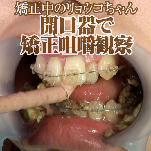 口／咀嚼フェチ】食べて噛んで出す『唇・口・舌・歯』（一眼レフカメラ） | デジタルコンテンツのオープンマーケット Gcolle