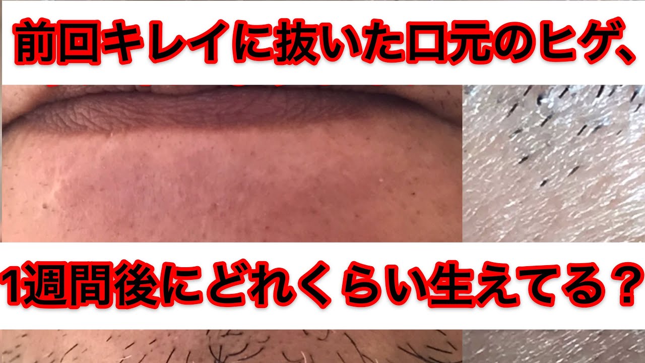 ケノンは髭脱毛に効果あり！3年間使い続けた効果と使い方を紹介します！ | ミツケル