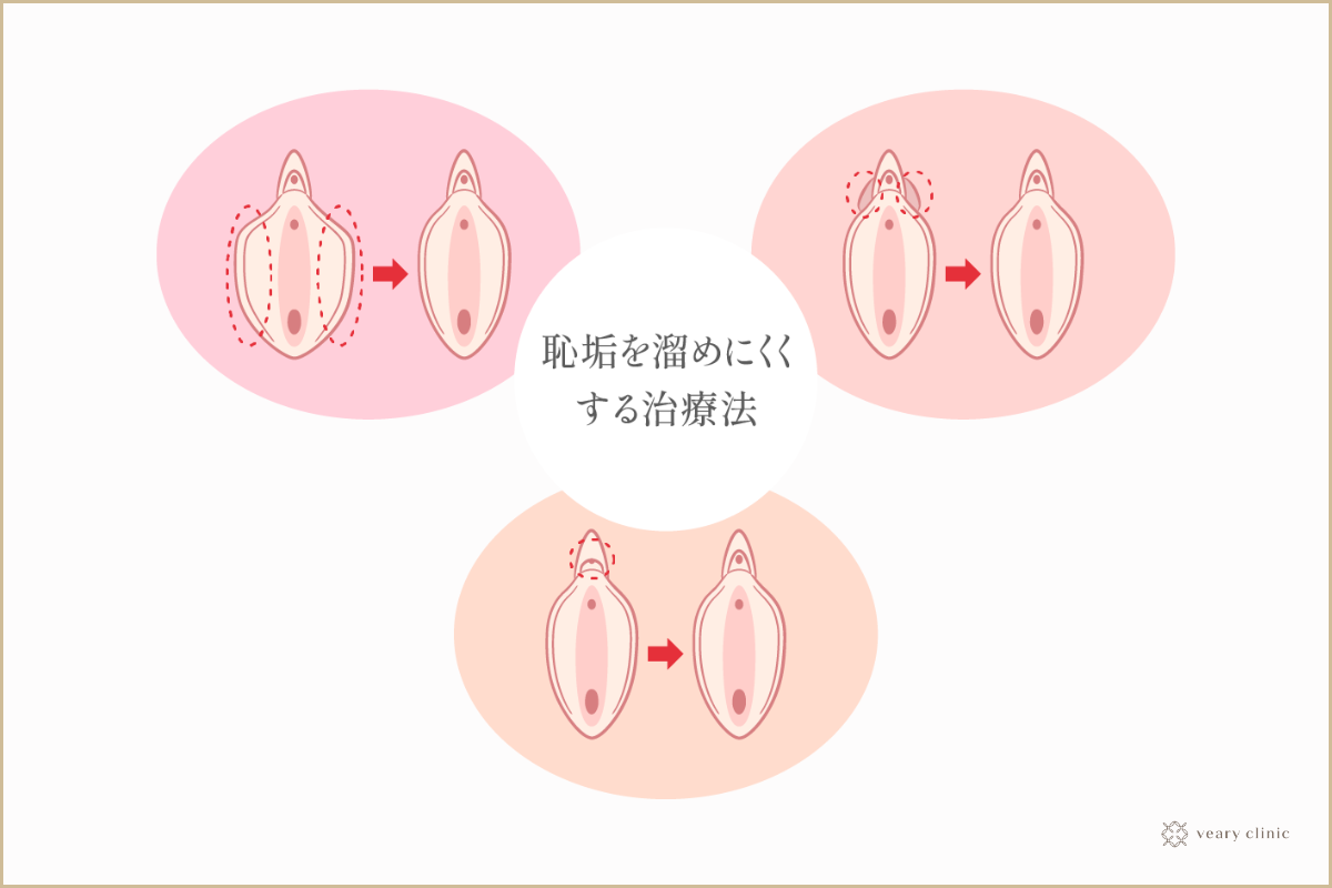 クリトリスの皮を剥くコツは？クリイキするための正しい剥き方をイラストでチェック