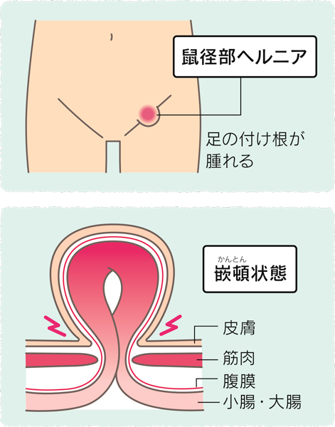 鼠径ヘルニア・脱腸のの基礎知識｜和歌山県和歌山市の鼠径ヘルニア・脱腸日帰り手術専門「楽クリニック」