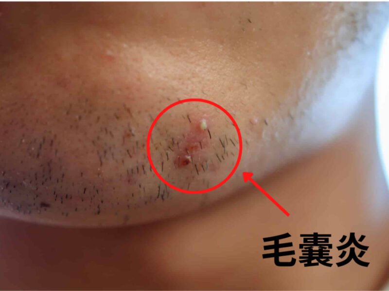 毛抜き職人 Hair Removal Specialist