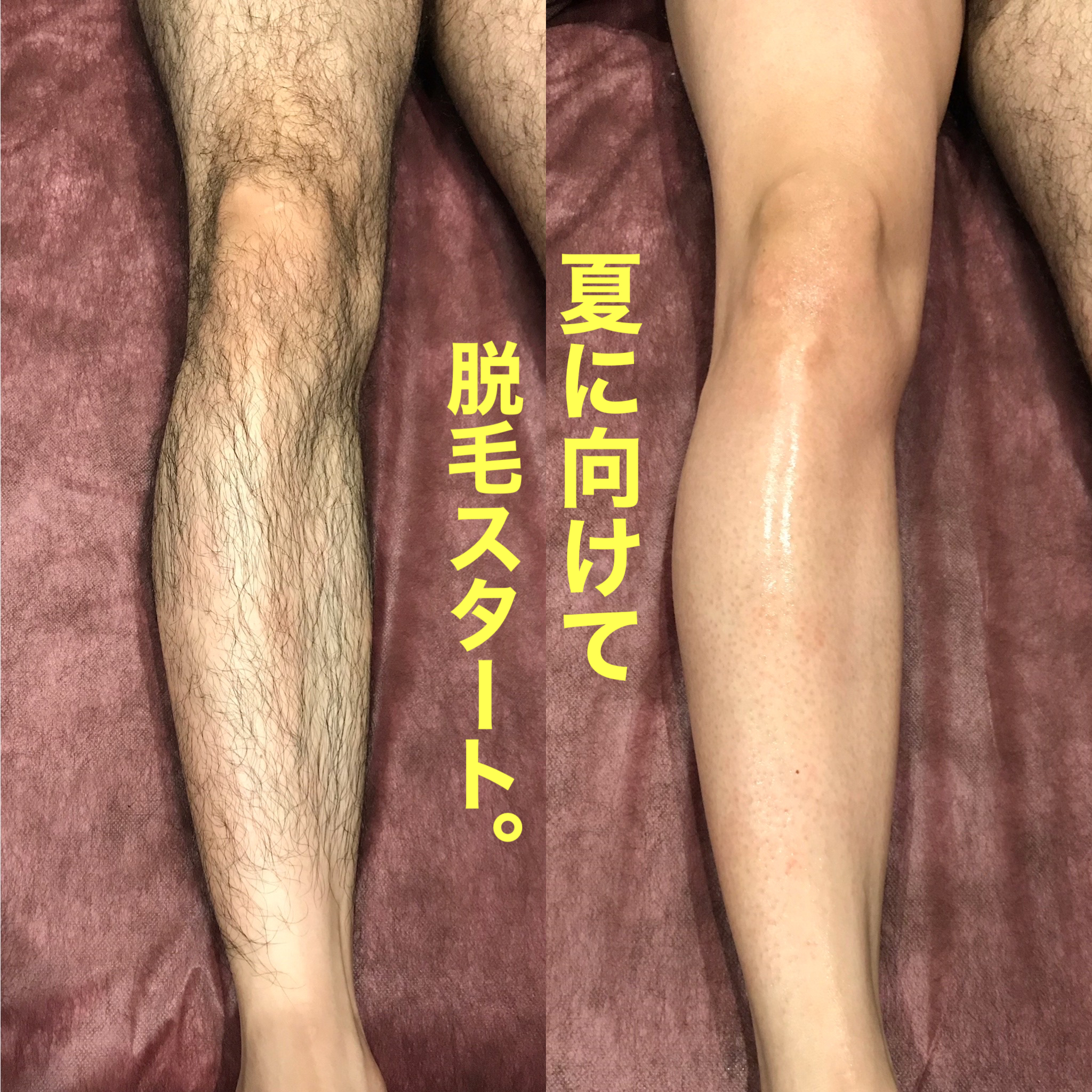 WaxWax】ブラジリアンワックス脱毛(男性用)2枚複写式同意書/A5 50枚の通販・卸売り | アイラッシュガレージ