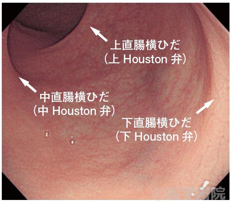 泡が直腸からS状結腸までひろがり、とどまる。｜製品情報｜レクタブル｜キッセイ薬品工業株式会社