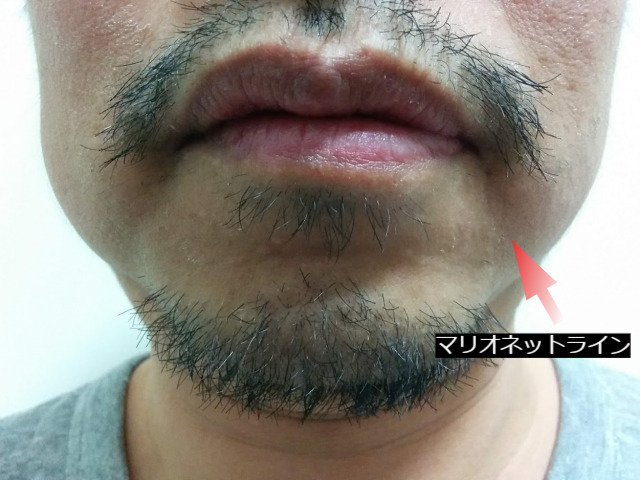 デカ顔、薄毛、たるみ】に悩む49歳男性が渋いイケメンに大変身！何をした？ | 美ST ONLINE