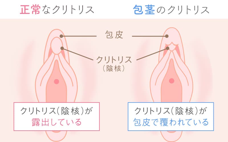 クリトリスが痒い痛い！かゆみ痛みの原因と予防について | 腟ペディア（チツペディア）