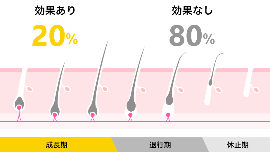 ヒゲを抜き続けると肌がボロボロに！確実にヒゲの悩みを解決する方法 | メンズ脱毛百科事典 リンクスペディア