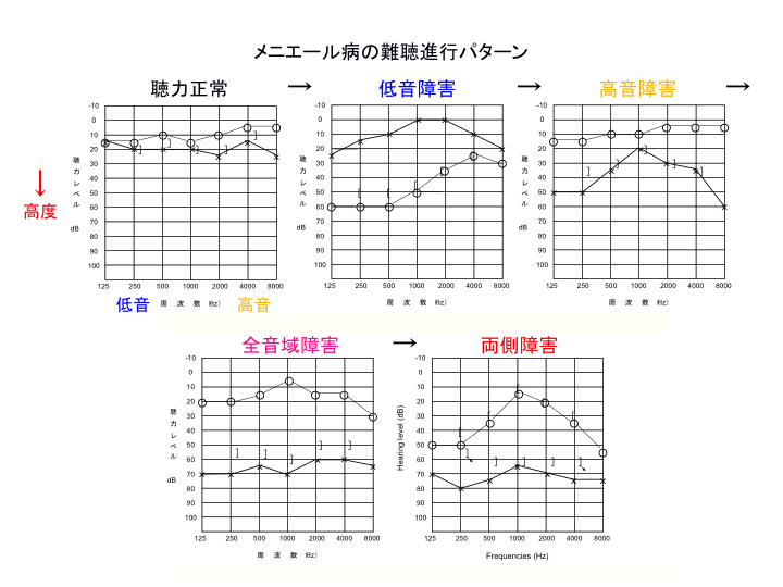 貧血でめまい、立ちくらみが起きるのはなぜ？