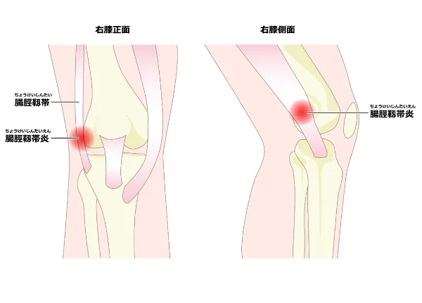 足底筋膜炎｜栄あおば接骨院はりきゅう院 - 栄の整体【栄あおば接骨院はりきゅう院】保険適用OK