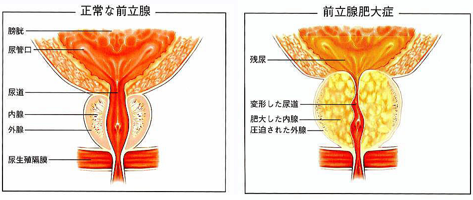 長茎術｜アトムクリニック