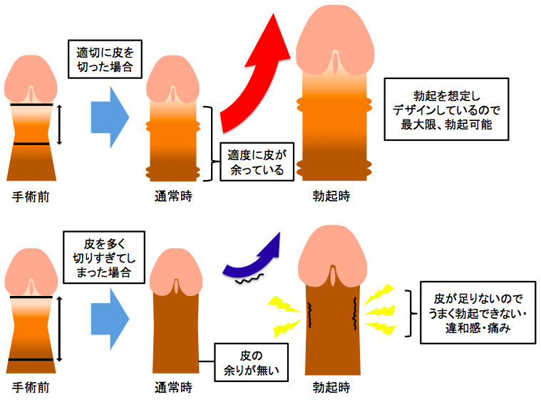 カントン包茎とは｜上野クリニック