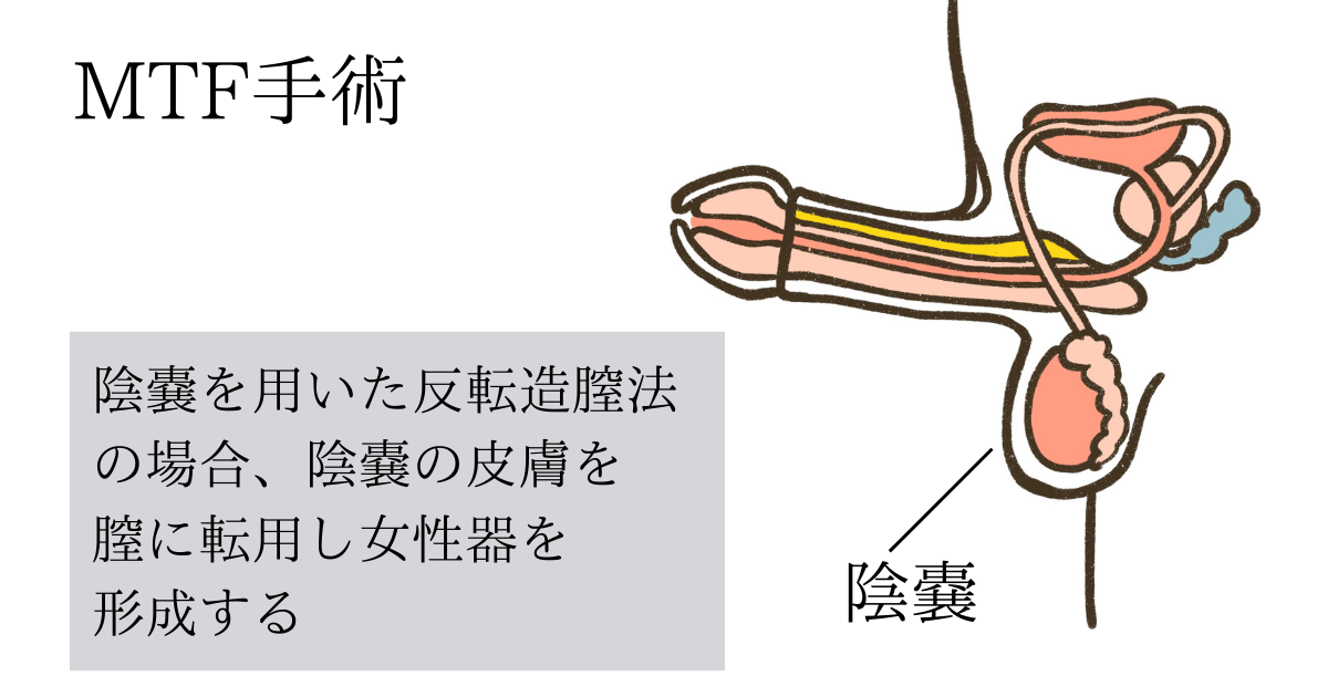 性転換手術から約３年過ぎたのでリアルなガチ話を赤裸々に（SEX、恋愛、身体、女子アナ） | スザンヌみさき公式ブログ