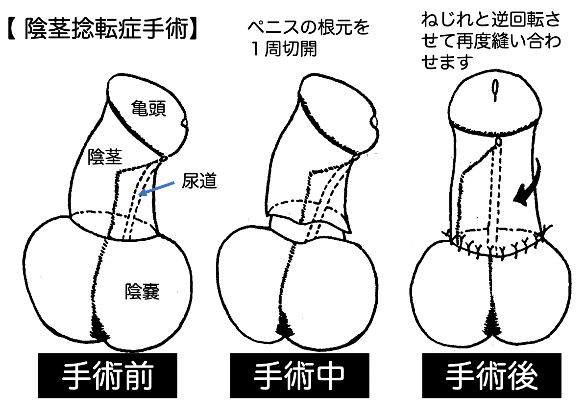 ペニスが曲がってる原因と治し方。お金をかけずにまっすぐに治す！ | VOLSTANISH