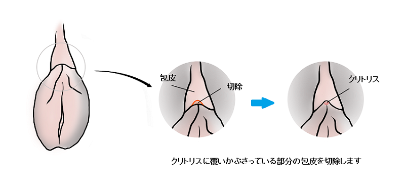 クリトリス包茎｜クリニーク大阪心斎橋本院・梅田院・名古屋院・福岡院