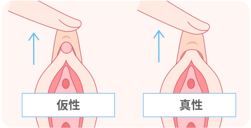 皮を剥くってどこまで？」男児のむく・むかない問題の曖昧さ【医師に聞く】｜CHANTO WEB