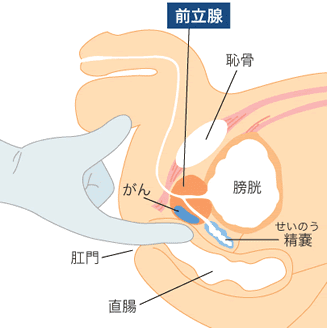 慢性前立腺炎｜神戸市東灘区 摂津本山｜いしむら腎泌尿器科クリニック