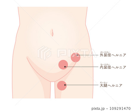 鼠径部緊張外傷および引っ張られたまたは引き裂かれた筋肉損傷の解剖学的概要図のイラスト素材・ベクター Image 186931819