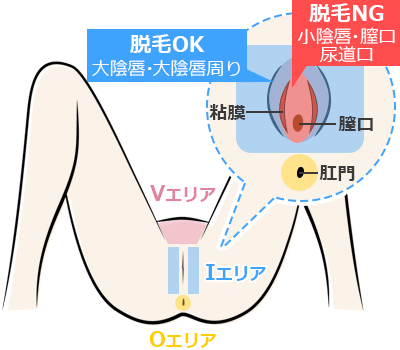 デリケートゾーンの黒ずみがひどい治し方｜陰部VIOの色素沈着