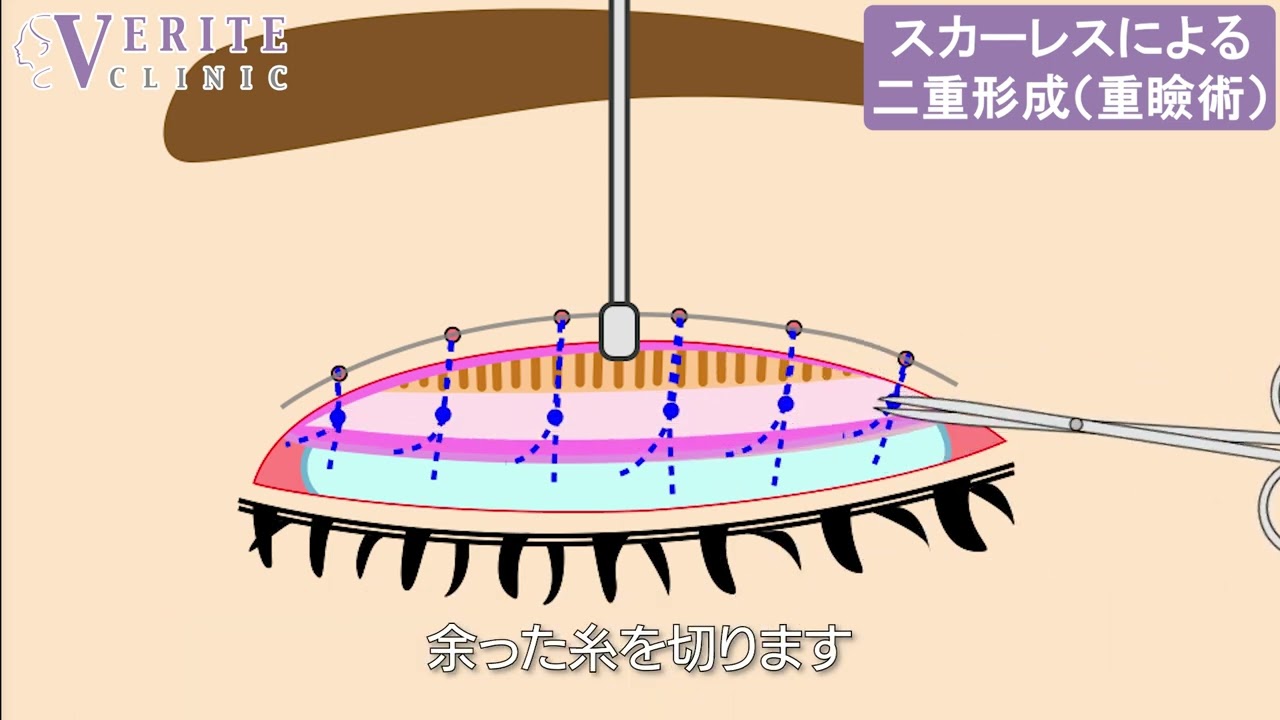 全切開法や埋没法と比べるとスカーレス二重術はどのくらい取れやすいのか？ | 失敗しないための美容相談所～整形ブログ・名医の条件・山口