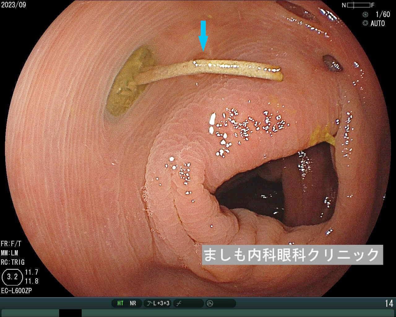 大腸がん（結腸がん・直腸がん） 治療：[国立がん研究センター がん情報サービス 一般の方へ]