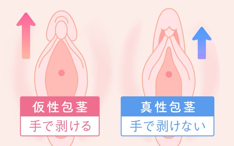 包茎がセックスに与える5つの影響！代表的な悩み＆注意点と治療法 - アトムクリニック