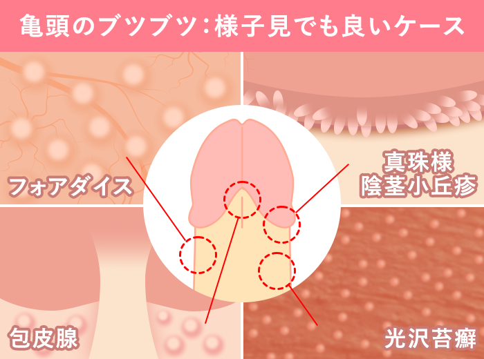 ペニス黒いについて | 医師に聞けるQ&Aサイト