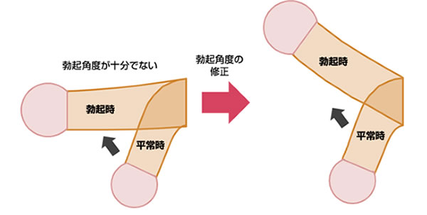 反りチンの原因は？欠点だけじゃないメリットと直し方も教えます！ | Trip-Partner[トリップパートナー]