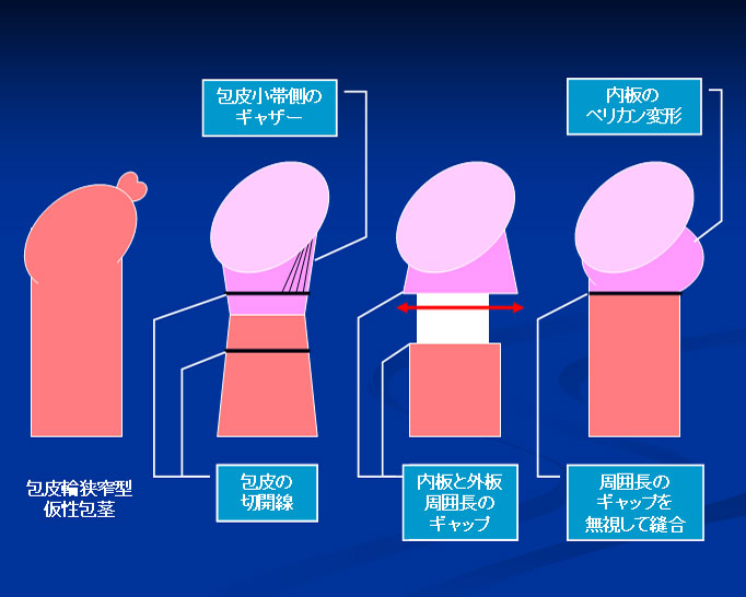 仮性包茎とは｜上野クリニック