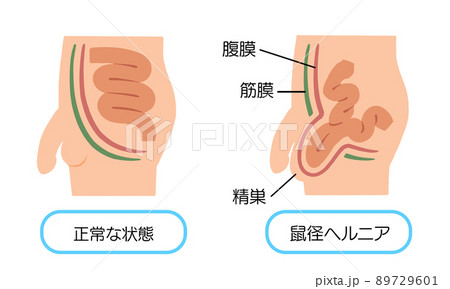 11,820件の「鼠径部」の画像、写真素材、3Dオブジェクト、ベクター画像 | Shutterstock