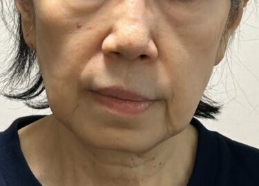 男性が老けて見える原因は？フェイスリフトで若見えを実現 - 渋谷の美容外科・美容整形クリニック