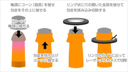 包茎｜神戸市東灘区 摂津本山｜いしむら腎泌尿器科クリニック