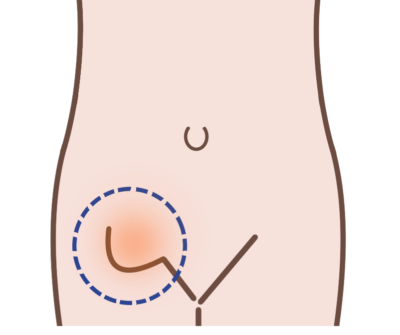 鼠径部（足の付け根）にしこりや痛みを感じる病気について紹介 - MIDSクリニック┃大阪梅田駅直結,鼠径 ヘルニア(脱腸),虫垂炎(盲腸),日帰り手術専門クリニック